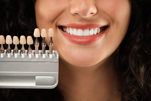 All-Inclusive Full Mouth E-max® Veneer Package